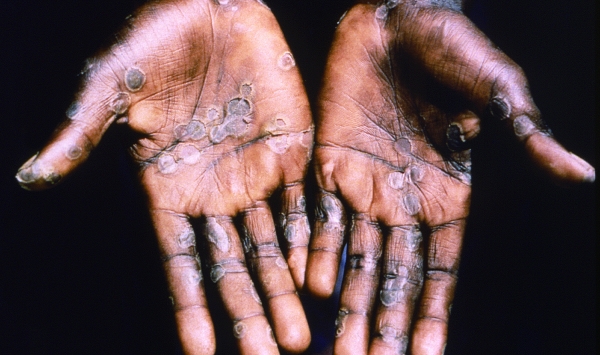 원숭이 두창에 감염된 손, 원숭이 두창은 아프리카 풍토병으로 현재 20여 개국으로 번졌다.